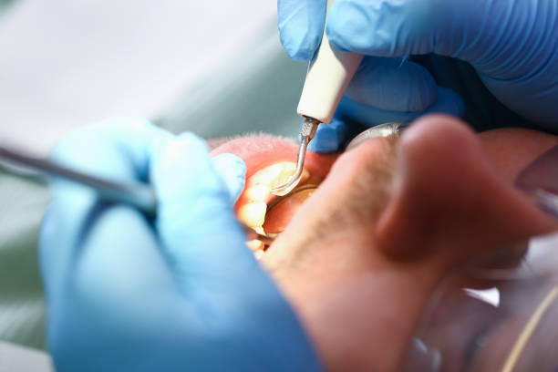 Best Emergency Root Canal Treatment in Weaverville, NC