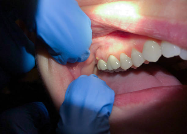 Best Emergency Dentist for Knocked-Out Tooth in Weaverville, NC